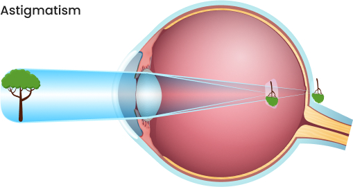 Astigmatism img