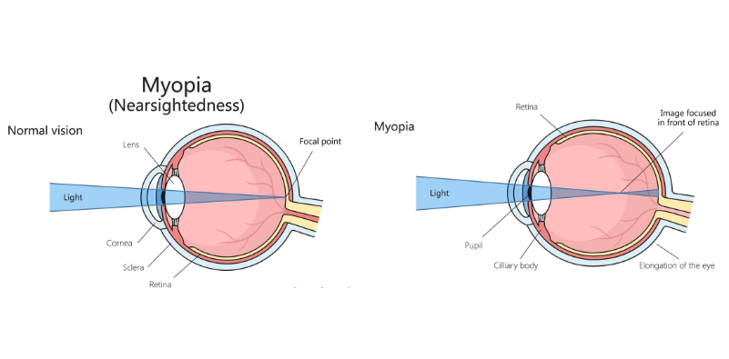 A diagram of a normal eye alongside an eye with myopia.
