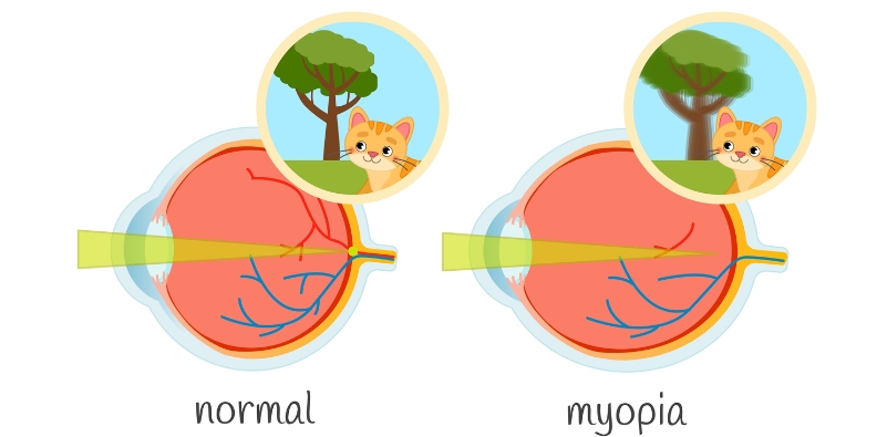 A diagram of a normal eye showing what vision would look like of a cat and a tree, with a diagram of a myopic eye with a cat and a blurred tree